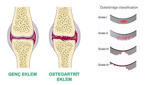 diz eklemlerinin deformasyonu ile osteoartrit tedavisi